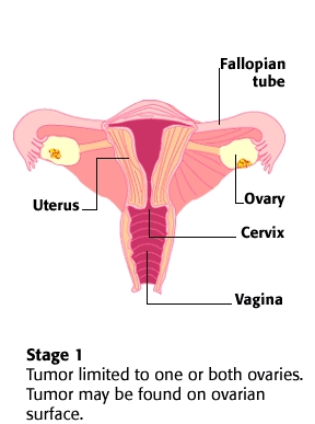 Stage 1 Ovarian Cancer