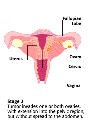 Stage 2 Ovarian Cancer