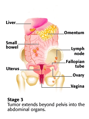 Stage 3 Ovarian Cancer