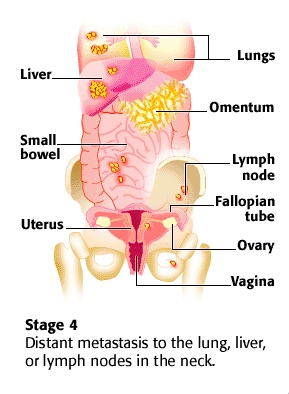 Stage 4 Ovarian Cancer