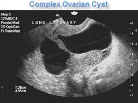 Complex Ovarian Cyst