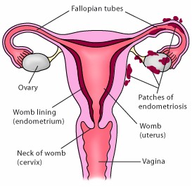 Endometriosis and Ovarian Cancer
