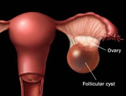 Types of Ovarian Cysts