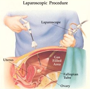 Laparoscopy and Ovarian Cancer