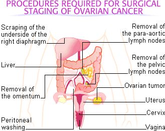 Ovarian Cancer Stages