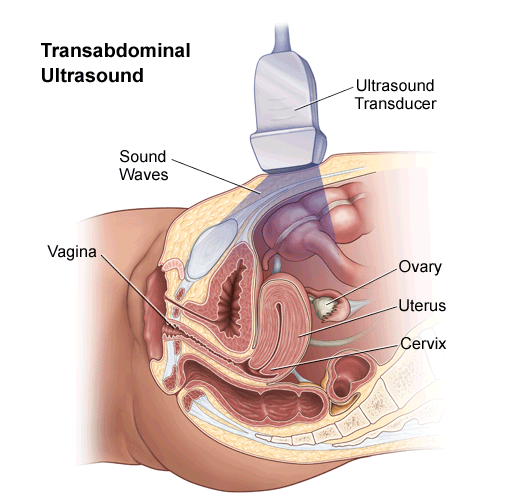 Ovarian Cancer Ultrasound