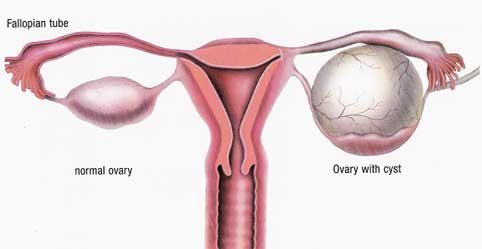 Ovarian Cyst Overview