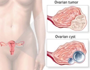 Difference Between Ovarian Cancer and Ovarian Cysts