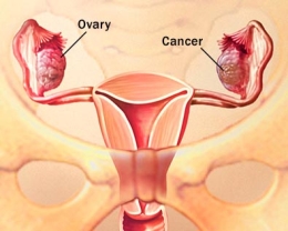 How is an Ovarian Tumor Classified?