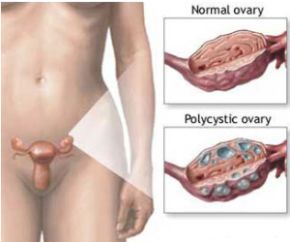 Polycystic Ovarian Syndrome (PCOS)