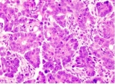 Epithelial Carcinoma