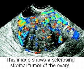 Sex Cord Stromal Tumor