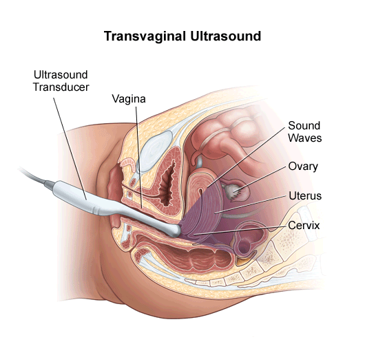 Transvaginal Sonogram